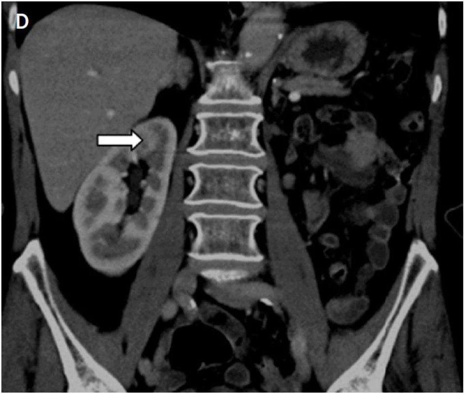 A – na koronárním skenu je patrná metastáza adenokarcinomu v horním pólu solitární ledviny před IRE (šipka); B – uložení dvojice elektrod v oblasti nádoru; C – nekrotické ložisko v místě nádoru po IRE; D – při kontrolním MR vyšetření za 6 měsíců jen jizevnaté změny v oblasti původního nádoru (šipka)