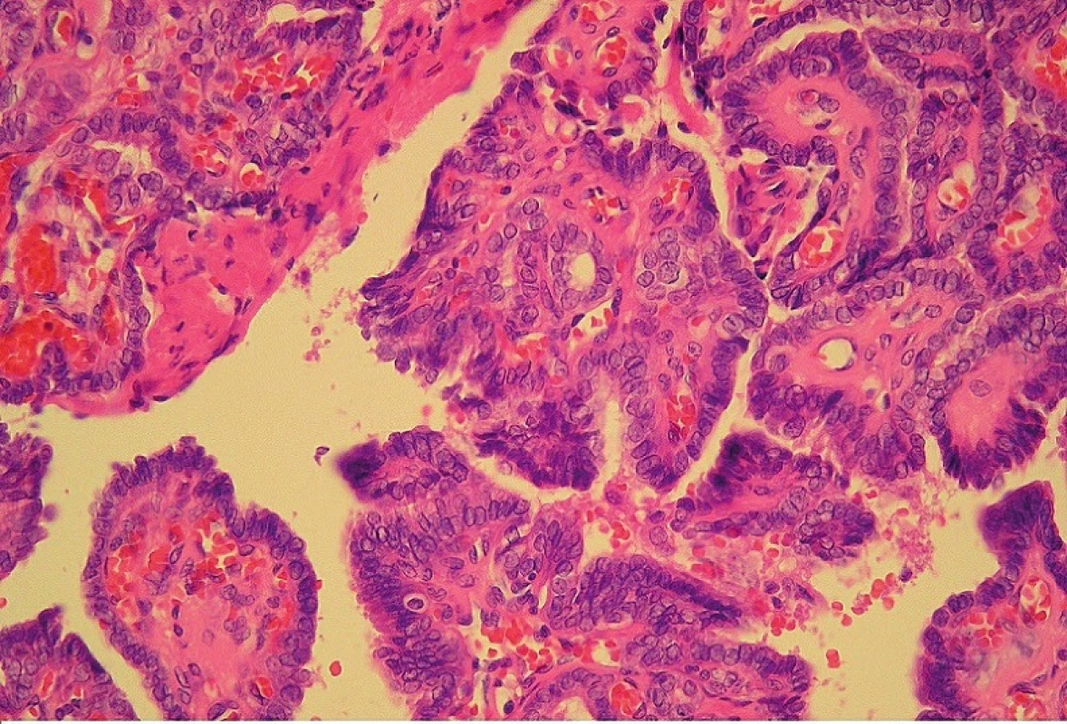 Papilární karcinom v mediální krční cystě (mikroskopické zvětšení 400x).