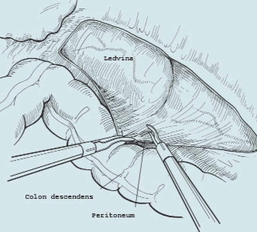 Laterokolické otevření zadního peritonea.
