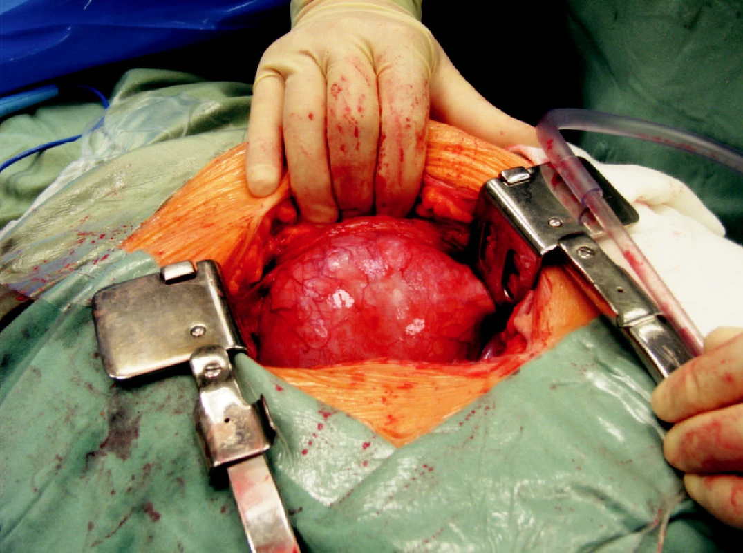 Objemná lymfokéla, která vyklenuje do operační rány
Fig. 4. A large lymphocele, buldging into the surgical wound