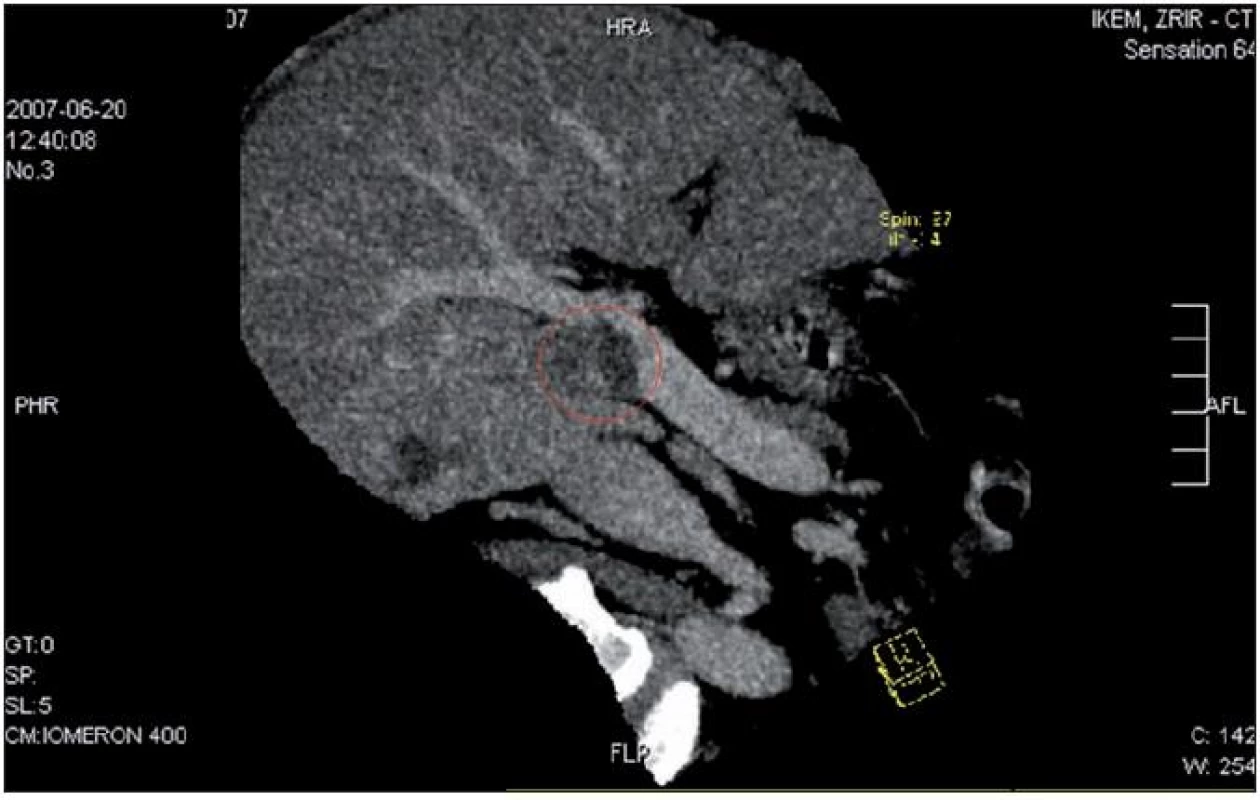 Červen 2007, angio CT, červeně je vyznačena propagace tumoru do lumen portální žíly