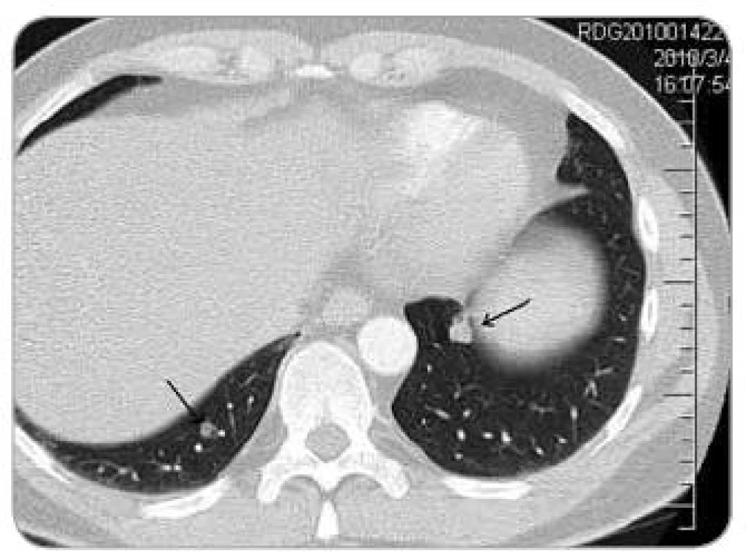 CT březen 2010 – plicní metastáza.