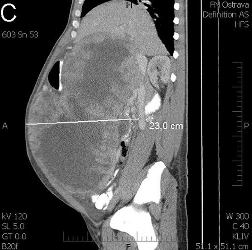 CT vyšetření před operací zobrazuje obrovský cystický tumor vyplňující celou břišní dutinu (A - transverzální řez, B - frontální řez, C - sagitální řez)
Fig. 1: CT scan before surgery shows a huge cystic tumour filling the entire abdominal cavity (a – transversal section , b – frontal section, c – sagittal section)