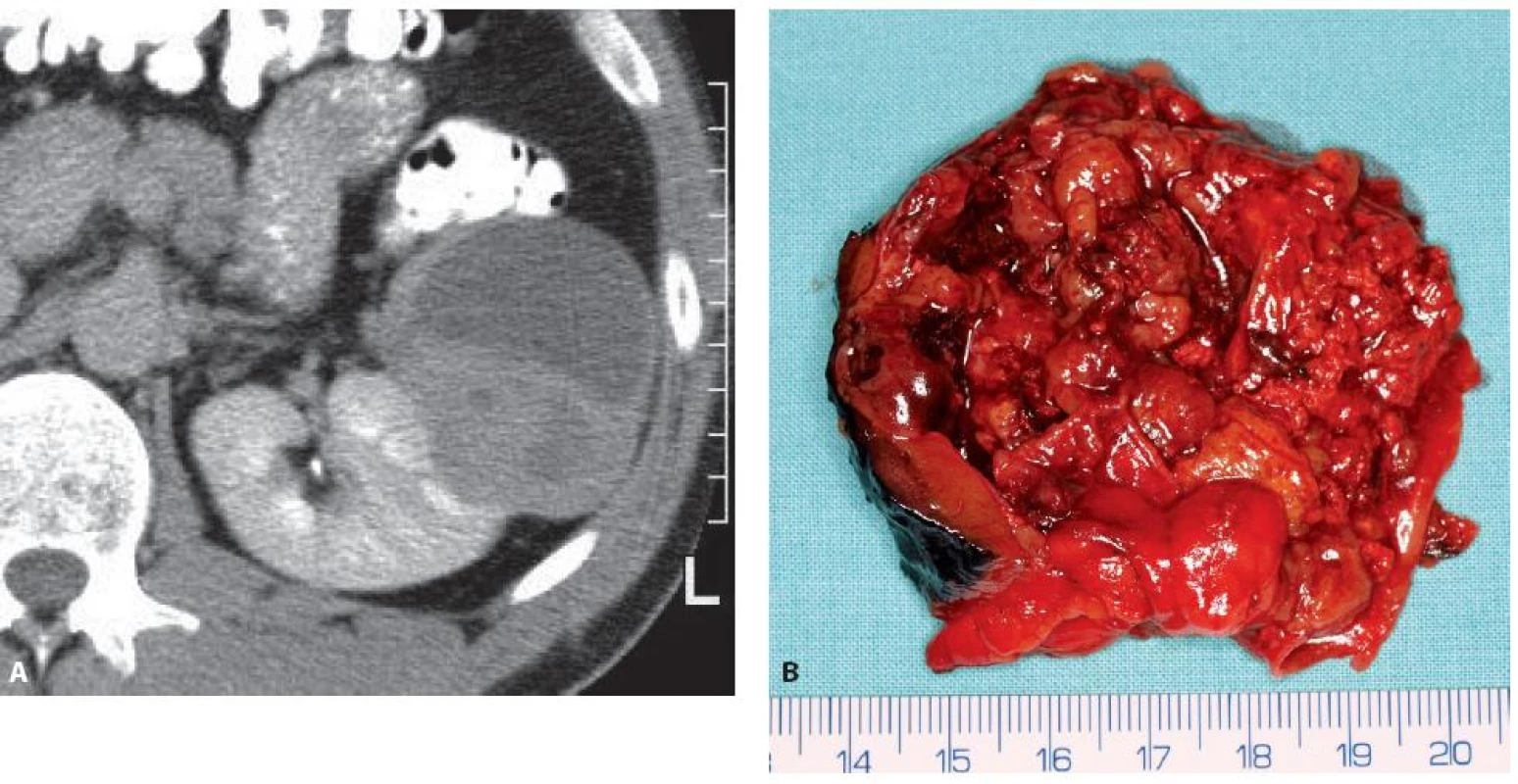 Epiteloidní angiomyolipom levé ledviny 71 mm v největším rozměru u 44letého muže. CT obraz ani operační preparát z resekce ledviny nepřipomíná klasický angiomyolipom.
Fig. 10. Epithelioid angiomyolipoma of the left kidney 71 mm in a 44-year-old man