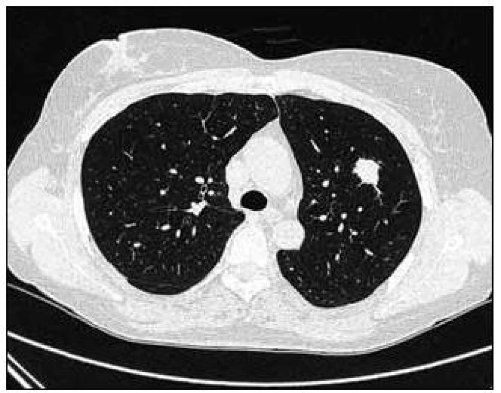 Vstupní vyšetření, největší denzní ložisko s nepravidelnými cípatými okraji v plicním parenchymu vlevo při CT zobrazení v tzv. „plicním okně“.
