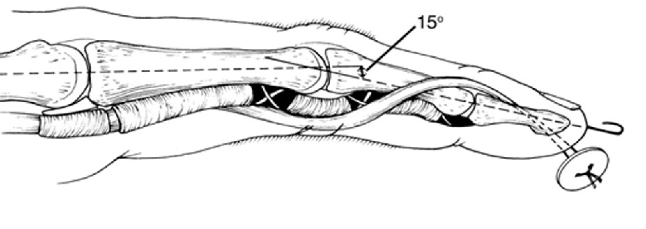 Rekonštrukcia ORL šľachovým transplantátom 
Koniec transplantátu sa prišije na terminálny extenzor, vedie sa medzi flexorovou šľachou a volárnou platničkou PIP kĺba, prevedie sa diafýzou proximálneho článku a zafixuje sa na opačnej strane na koži cez gombík [11].
Fig. 10: ORL reconstruction with the tendon graft 
One end of the tendon graft if fixed to the terminal extensor. The graft is passed between the flexor tendon and PIP joint volar plate, then through the diaphysis of the proximal phalanx and fixed on the opposite site on the skin through the button [11].