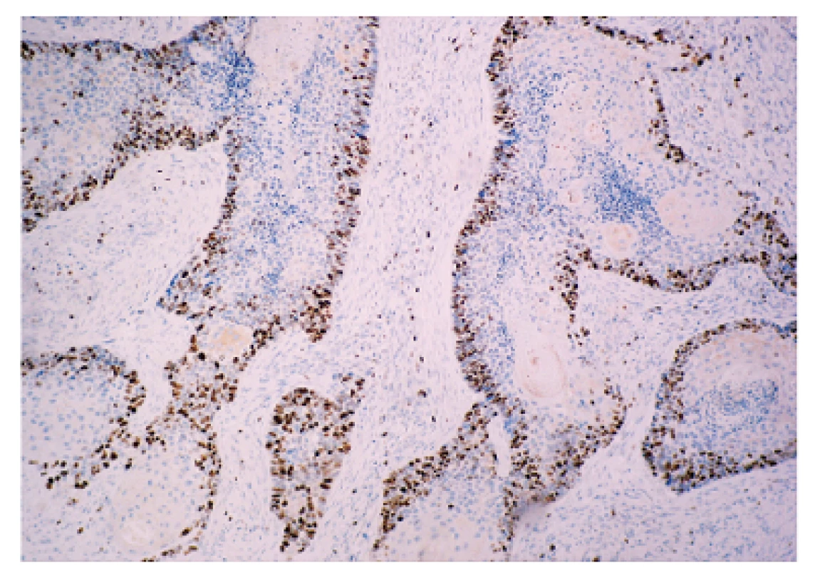 Imunohistochemické farbenie bazoskvamóznej časti karcinómu na proliferačný marker Ki-67. Prítomná pozitivita cca 35 % nádorových buniek, najmä v periférnych bazaloidných úsekov (Ki-67, DAKO, zvačšenie 240x).