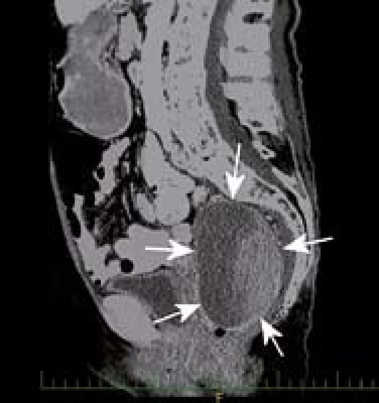 CT malé pánve s expanzí (označeno šipkami) komprimující močový měchýř.