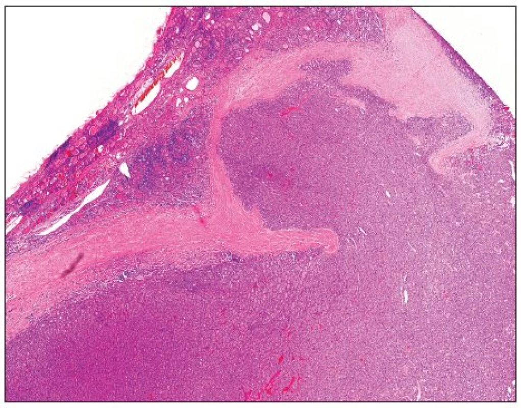 Folikulární tumor nejistého maligního potenciálu s penetrací nádorových buněk do pouzdra, nikoli však skrze celou jeho tloušťku (H&amp;E, 40krát)