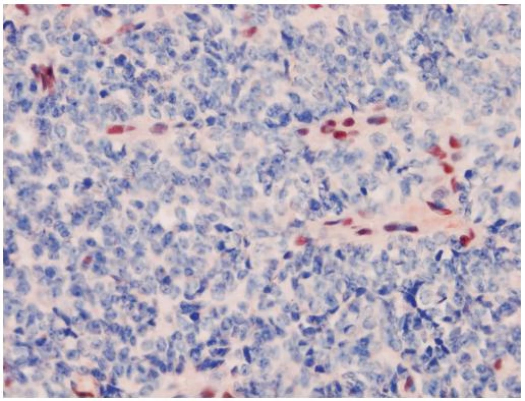 Strata jadrovej expresie INI1 je charakteristická pre tumory typu AT/RT. Pozitívnou vstavanou kontrolou sú lymfocyty a cievy. Išlo o resekát tumoru mozgu jednoročného chlapca. Nádor ani pri kompletnom spracovaní nevykazoval žiadne rabdoidné bunky. Imunohistochémia INI1, zväčšenie 400 x.