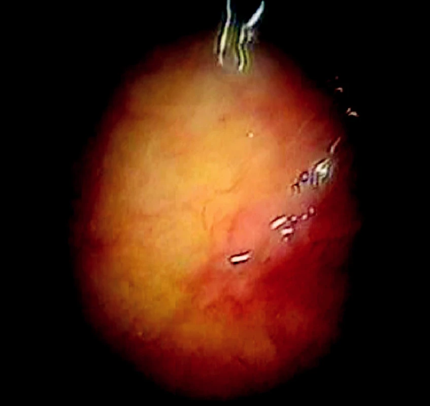 Okraje nádorovej infiltrácie v bielom svetle
Fig. 5. Tumorous infiltration margins in white light