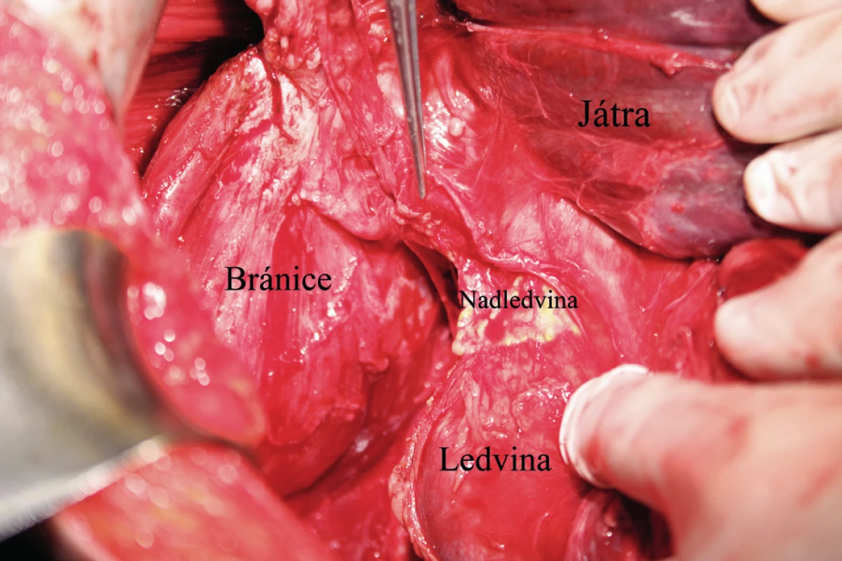 Pohled na pravou ledvinu a nadledvinu po kompletní mobilizaci pravého laloku jater a jeho mediální rotaci