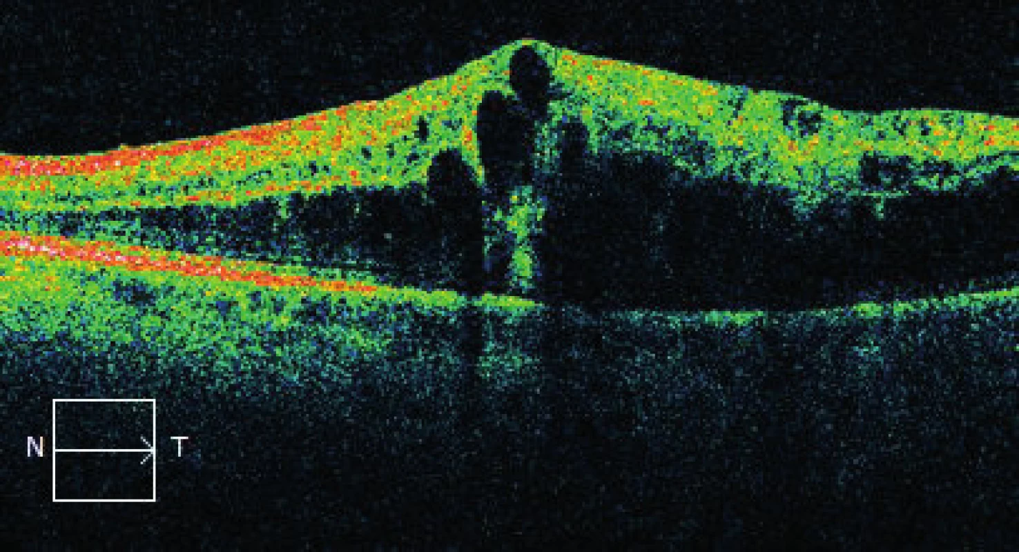 Makrocystický otok makuly prokazatelný na OCT OL (Cirrus, Zeiss)