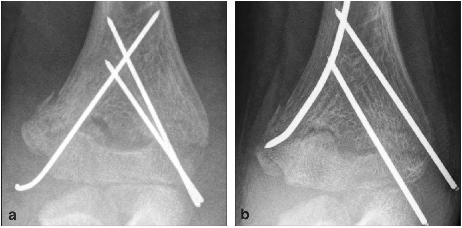 Rtg snímky ľavého lakťa 10-r. chlapca s iatrogénnou léziou n. ulnaris
1a – AP proj. po primárnom ošetrení, 1b – AP proj. Re-OS 2. deň po primárnom ošetrení
Fig. 1: X-rays of the left elbow, 10-years-old-boy with iatrogenic lesion of nervus ulnaris
1a – anteroposterior X-ray after primary treatment, 1b – anteroposterior X-ray after reosteosynthesis