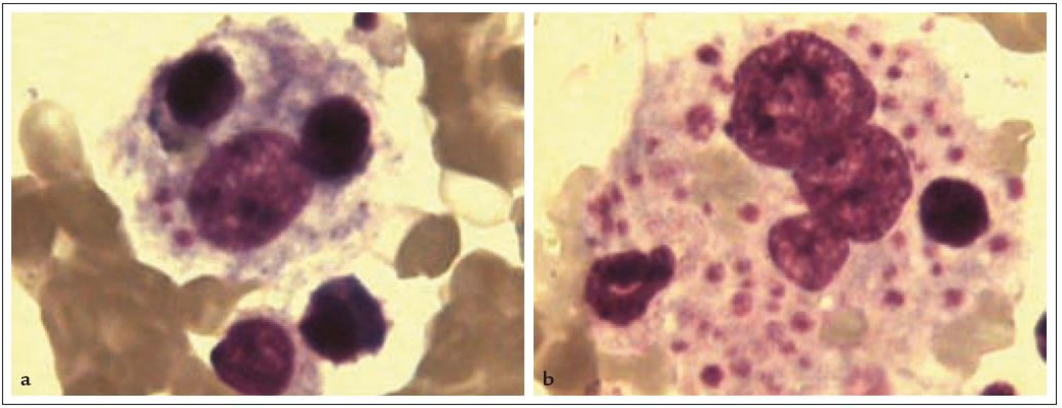 Hemofagocytující makrofágy v kostní dřeni (barvení dle Pappenheima, zvětšeno 1 000krát).
1a: Makrofág s fagocytovaným mononukleárem, holým jádrem a destičkami.
1b: Makrofág s fagocytovanými destičkami, erytrocyty a jádry krvinek.