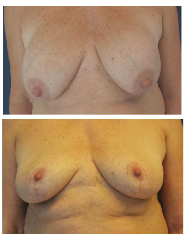 Modelace prsů u třiašedesátileté ženy
Fig. 5: Mastopexy in a 63 year old female