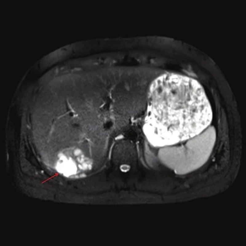 MRI, T2 weighted image, axial plane: the high signal intensity indicates the presence of a coagulation necrosis (red arrow). Calcification cannot be assessed.