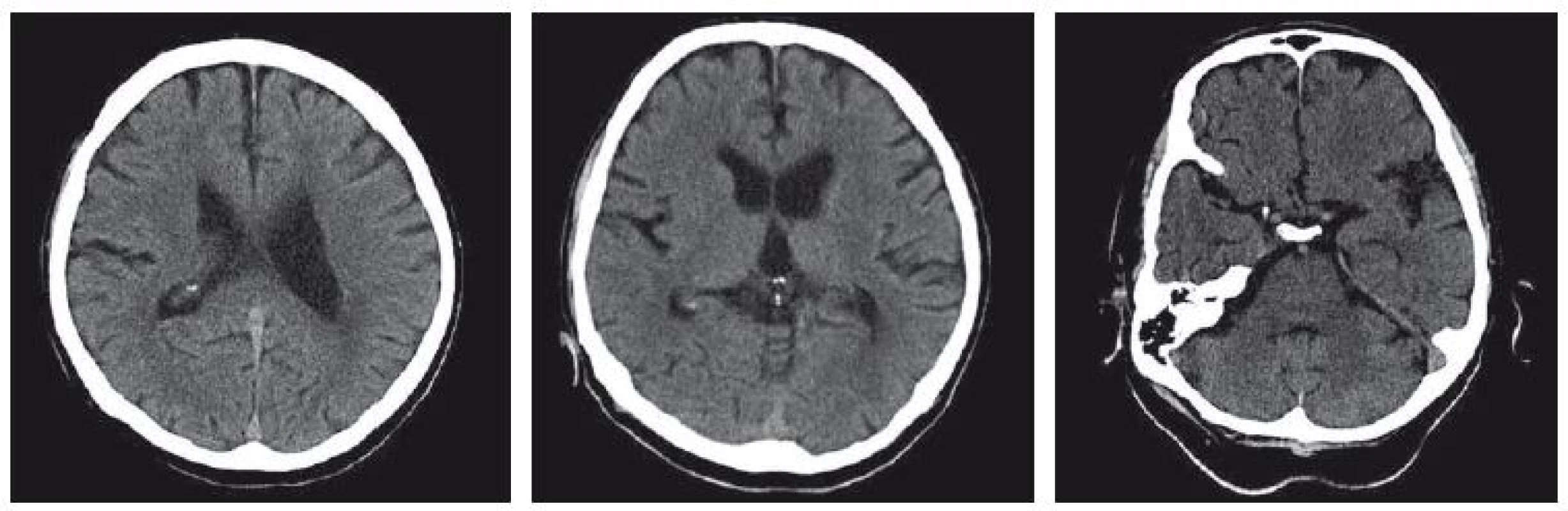 CT mozku z roku 2006, nativní zobrazení. Atrofie mozku kortikosubkortikální, lehké známky subkortikální mikroangiopatie, atrofie caput nuclei caudati oboustranně. <br>Fig. 1. CT brain scan from 2006, non-enhanced. Corticosubcortical atrophy and slight subcortical leukoaraiosis, bilateral atrophy of the caudate nucleus.