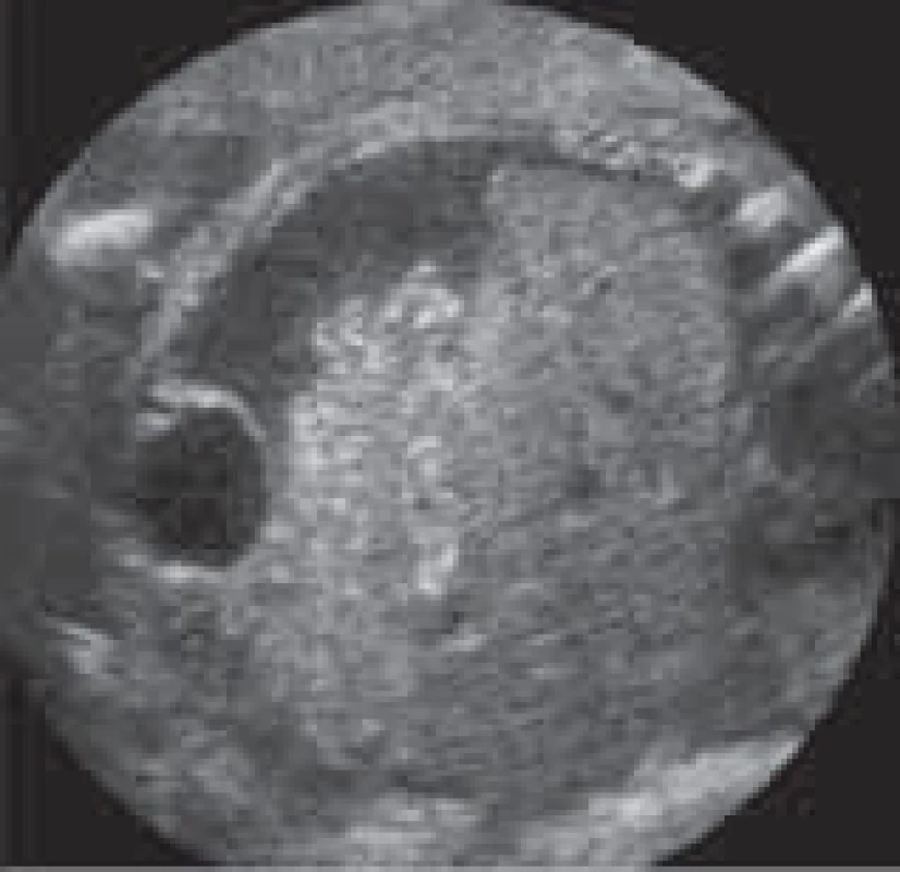 Hepatomegalie u plodu ve 33. týdnu těhotenství. A – močový měchýř, B – tlusté střevo, C – játra, D – obvod břicha (340 mm).