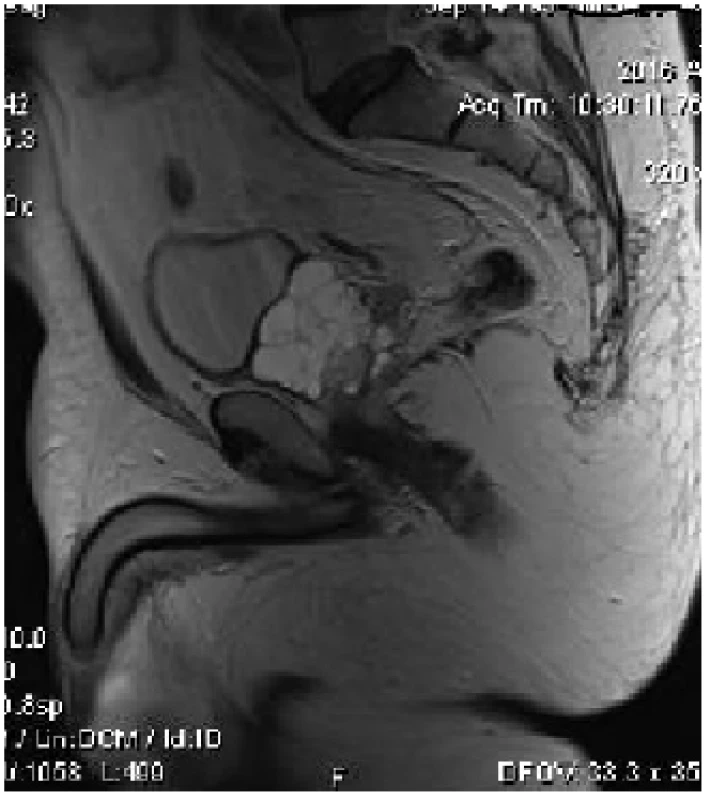 MRI sagitální řez – cystický nádor prostaty
Fig. 1 MRI sagittal plane – cystic tumor of prostate