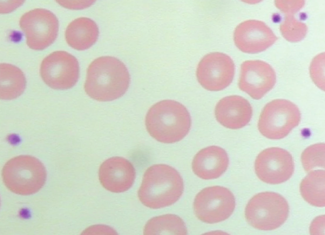 Pseudotrombocytopenie – bez známek agregace trombocytů v nátěru periferní krve odebrané do oxalátu (počet trombocytů odečtených analyzátorem – 206 x 109/l).