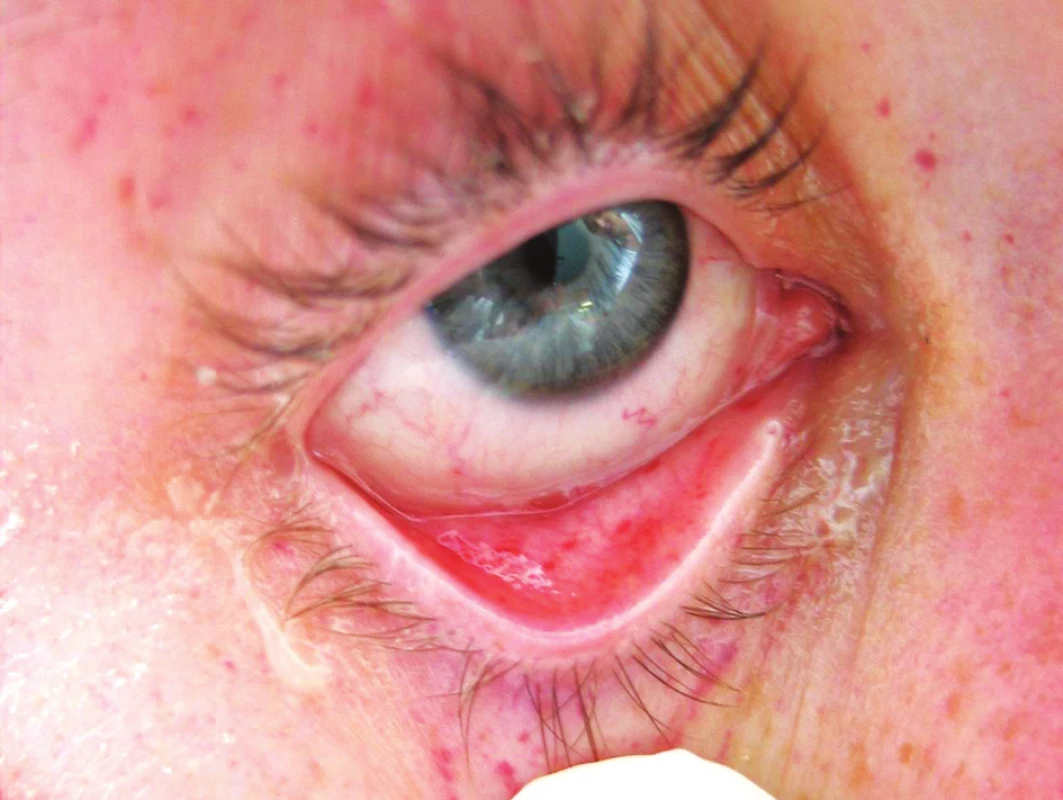 Syndrom tukové embolie – výsev petechií (oční víčko a spojivka)