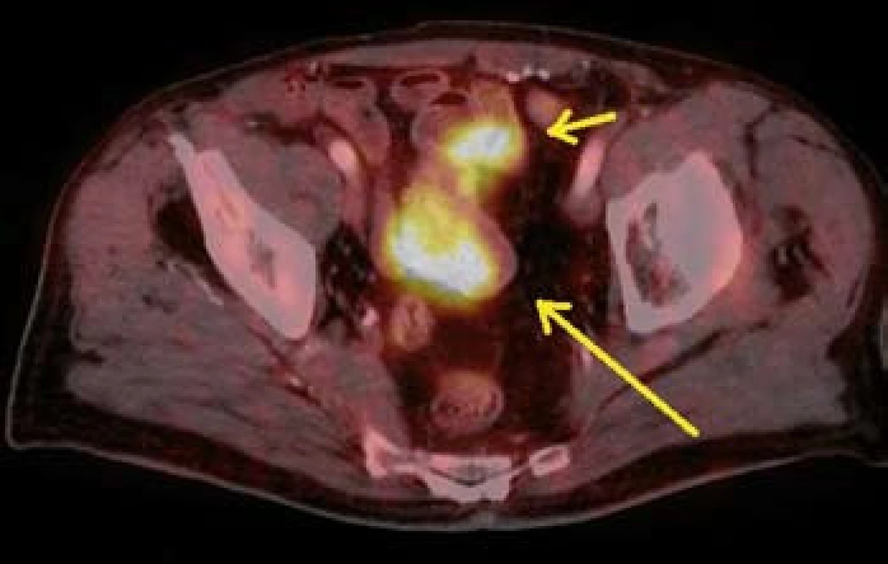 PET CT – metastáza v distálnější části tenkého střeva (šipky).
Fig. 10. PET CT – melanoma metastasis in lower part of small bowell (arrow).