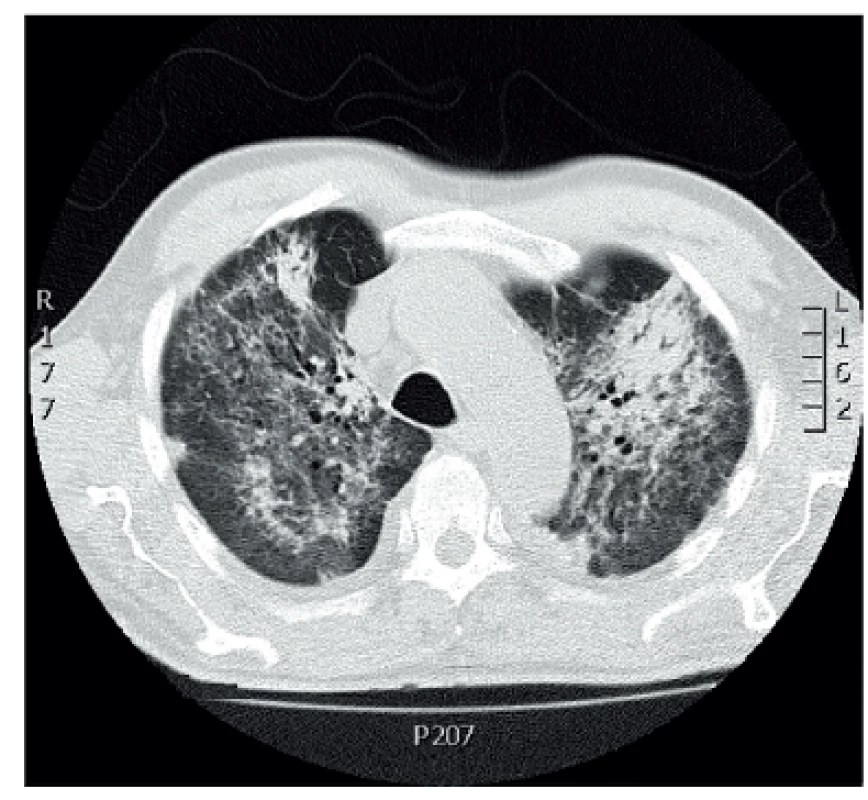 CT scan 75letého pacienta s ANCA pozitivní mikroskopickou polyangiitidou. Bilaterální plicní infiltráty.
