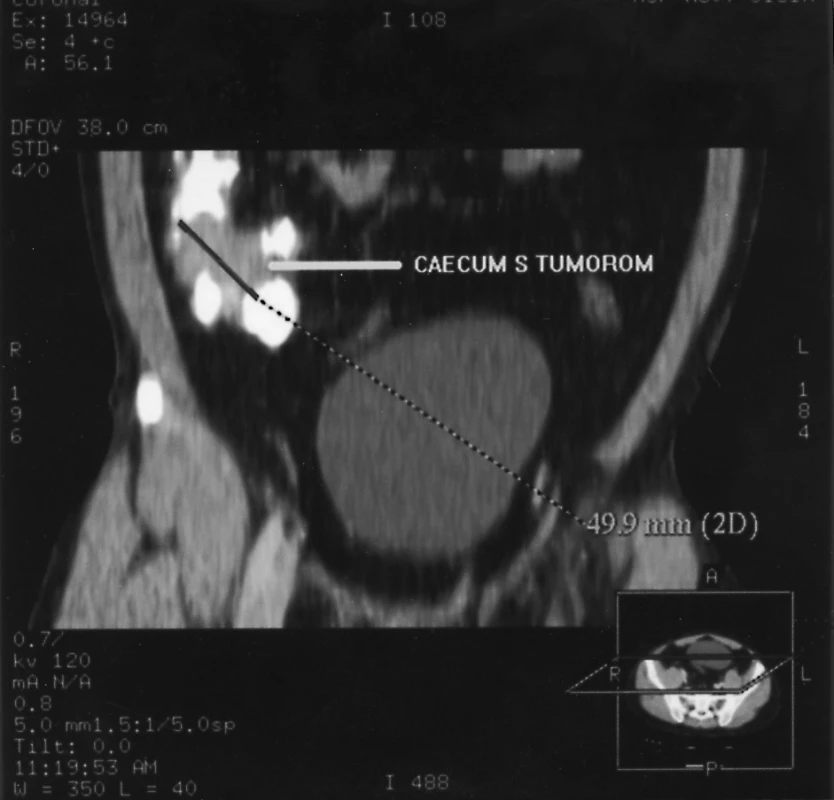 CT rekonštrukcia tumoru céka
Pic. 2. A CT reconstruction of the caecal tumor