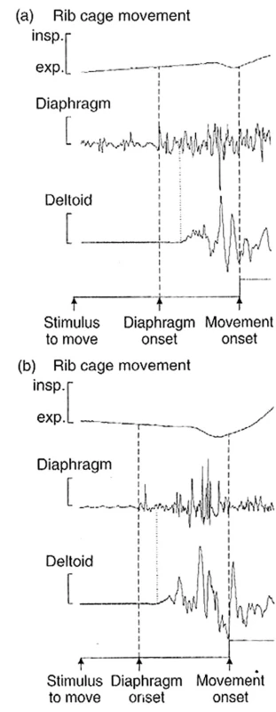 EMG aktivita m. deltoideus a kostální části bránice při rychlé flexi v ramenním kloubu. Aktivita v bránici předchází aktivitě v m. deltoideus jak při nádechu (a) tak i při výdechu (b). (Převzato z: Richardson C. A., Hodges P.W., Hides J. A.:Therapeutic Exercise for Spinal Stabilisation in Low Back Pain. 2. vyd., Churchill Livingstone, 2004.)