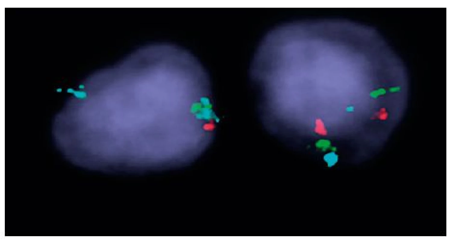 Výsledek I-FISH na separovaných CD34+ buňkách u nemocné č. 1 Trojbarevná sonda ON MDS 5q- EGR1 5q31; CSF1R 5q33/hTERT 5p15; vlevo buňka s delecí oblasti 5q31 a 5q33 (zelený signál 1krát a červený signál 1krát), modrý kontrolní signál (2krát) pro oblast 5p15, vpravo buňka 
s normálním nálezem.