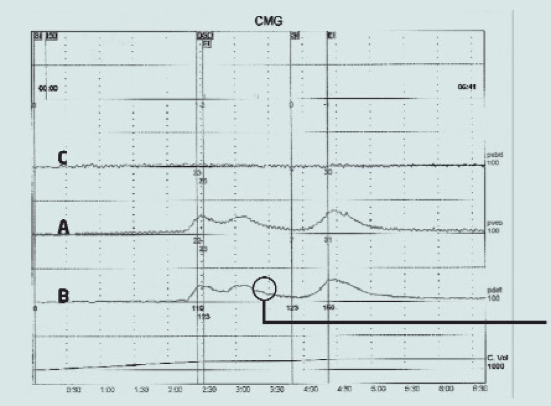Urodynamický nález idiopatické hyperaktivity detruzoru.
Zvýšení tlaku je zaznamenáno křivkou zaznamenávající intravezikální tlak (A) a křivkou zaznamenávající tlak detruzoru (B) bez odpovídajícího zvýšení křivky abdominálního tlaku (C). Tím dochází k mimovolní kontrakci svaloviny detruzoru během plnicí fáze, ve které pacient aktivně inhibuje každou motorickou aktivitu v močovém měchýři.