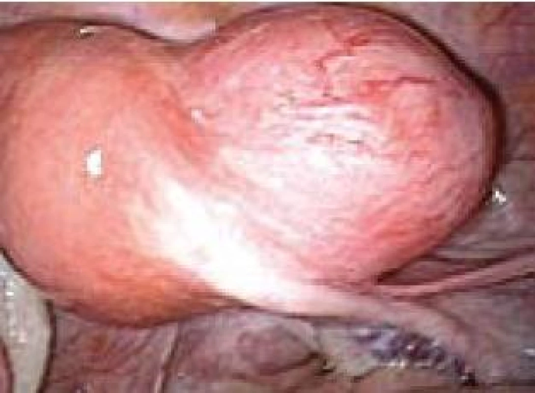 Subserózní myom v pravé hraně při rohu děložním.