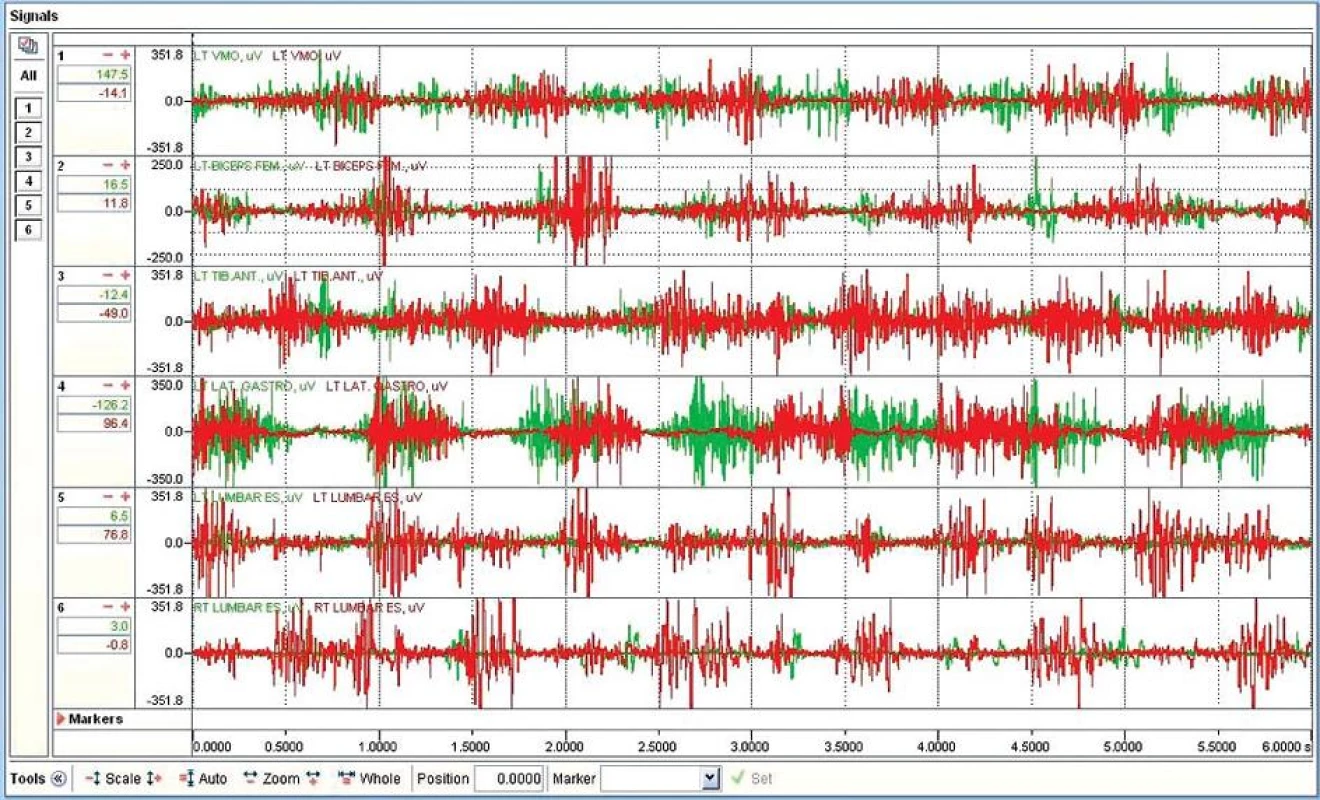 Posun fáze.
Zeleně je znázorněn EMG záznam pro jízdu na kole na suchu, červeně je znázorněna EMG křivka pro vodní prostředí.Ve spodní části grafu je umístěna časová osa zachycující úsek 0,0000 s - 6,0000 s. V každém řádku jsou záznamy elektrické aktivity jednotlivých svalů (v jednotkách μV). V první sekundě tohoto záznamu si křivky odpovídají, ve druhé sekundě již dochází ke zrychlení cyklistického kroku na suchu, a tím k posunu fáze cca o 0,2 s (dobře patrné u LT LAT GASTRO, tedy u m. gastrocnemius lateralis).