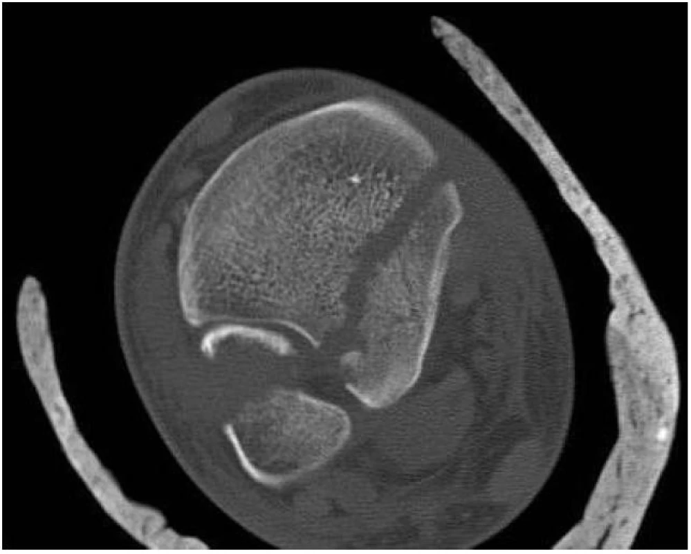 CT vyšetření ukazuje Earlův fragment zaujímající více jak  25 % kloubní plochy tibie a subluxovanou fibulu 