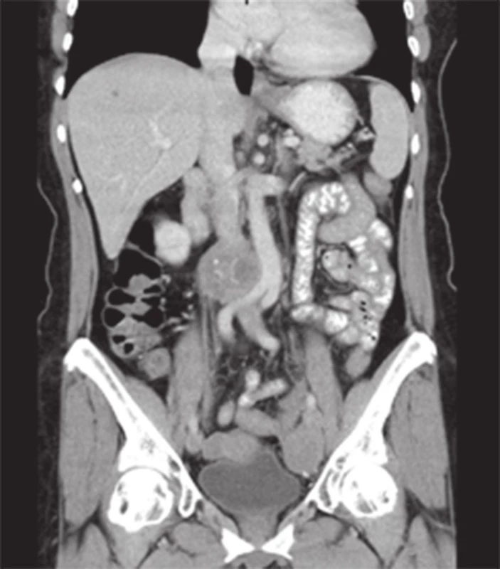 CT obraz primárního tumoru
Fig. 1: CT scan of the primary tumour