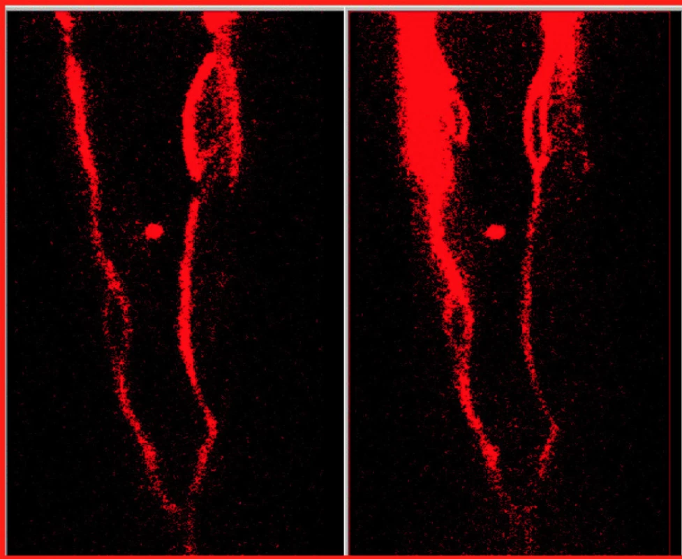 Radionuklidová flebografie s wholebody obrazy dolních končetin v přední projekci, s pohledem shora, kde v horní části obrazů je oblast kotníků, v dolní části projekcí je vykresleno spojení ilických žil do dolní duté žíly, oblast kolenních kloubů je mezi nimi označena markerem. Obraz vlevo je se zataženými škrtidly kolem kotníku a v podkolenní, obraz vpravo je po uvolnění škrtidel. V porovnání obou obrazů je patrný neprůchodný HŽS pravé dolní končetiny, kdy se nezobrazuje na obou obrazech HŽS od kolene výše, odpovídající oblasti neprůchodné v. parva a v. femoralis, dobře se vykresluje až v. iliaca, Aktivita se dostává do povrchového žilního systému, kde na obou obrazech je patrný průběh v. sapheny magny.