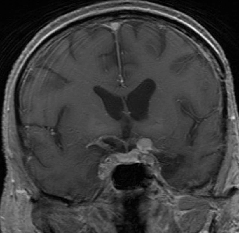 Kontrolní MRI 2 roky po výkonu prokazující progresi rezidua meningiomu (Na základě tohoto nálezu bylo indikováno ozáření na Leksellově gama noži)
Fig. 3: MRI 2 years after surgery showing the progression of residual tumor (Radiosurgery with the Leksell Gamma Knife was indicated based on this finding.)