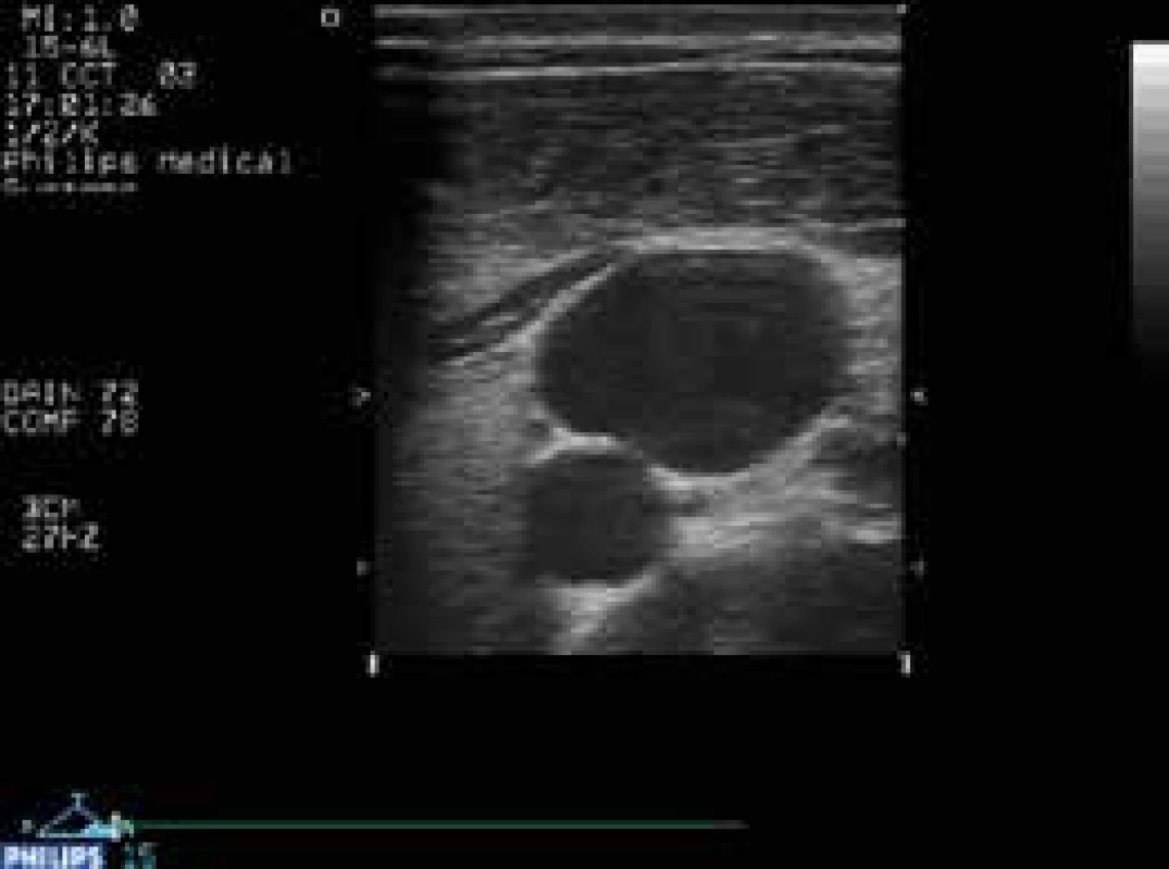 Levá vnitřní jugulární žíla přibližně na úrovni
vrcholu větvení sternálního a klavikulárního
úponu m. sternocleidomastoideus, okrouhlé
lumen pod ní a mediálně (z pohledu pacienta)
je levá společná karotida