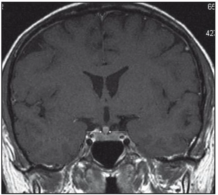 MR mozku v červnu roku 2006: postkontrastně se sytící ložiskové zbytnění stopky hypofýzy, T1 vážený obraz po aplikaci kontrastní látky, koronární rovina.