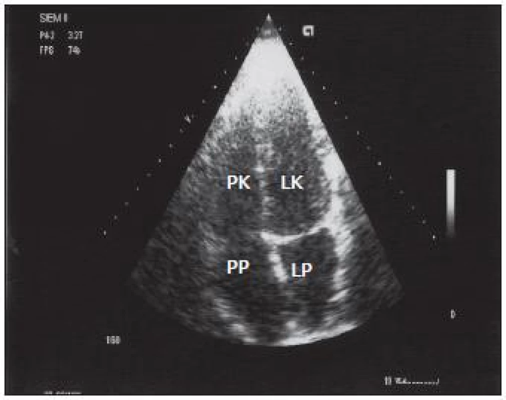 Transtorakálna echokardiografia z roku 2008, 4 mesiace po operácii, štvordutinová projekcia: normalizovala sa veľkosť pravej predsiene (PP) a pravej komory (PK), ľavá komora (ĽK), ľavá predsieň (ĽP).