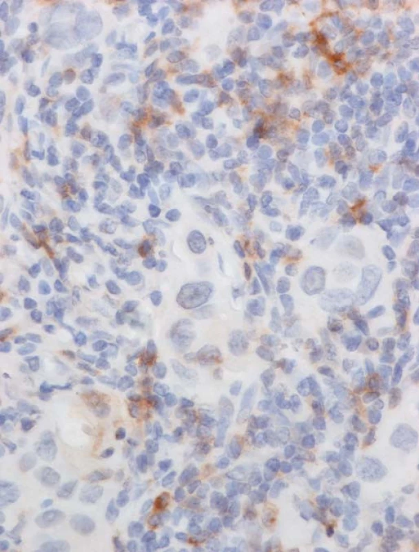 V detailu je patrná hustá infiltrace nádoru (světlejší ostrůvky) a jeho okolí lymfocyty pozitivními na PD-1.