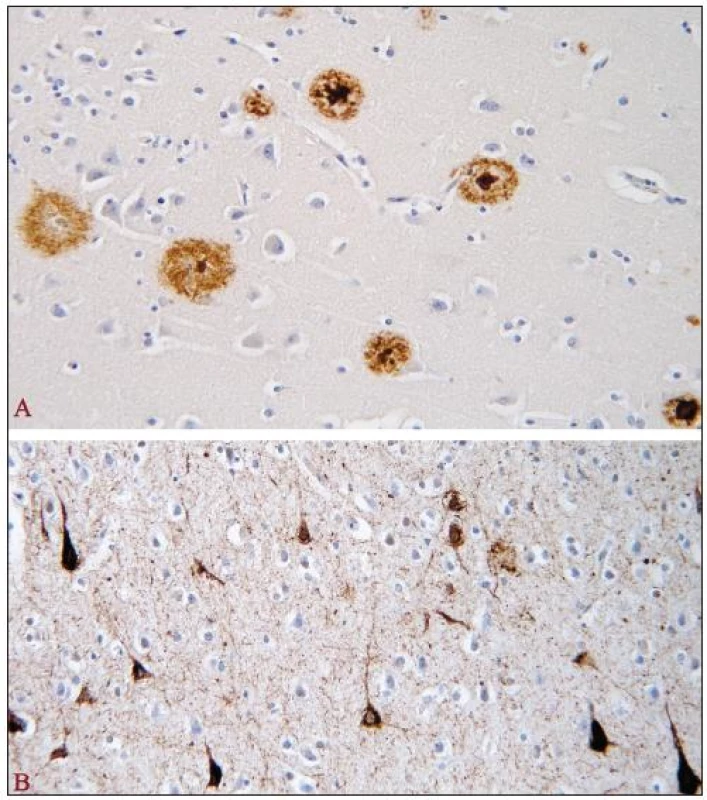 Amyloidové senilní plaky a neurofibrilární klubka u AN [18].
Amyloidové senilní plaky v hipokampální formaci pozitivní v imunohistochemické reakci s monoklonální protilátkou proti amyloid-β proteinu (A) a neurofibrilární klubka (tangles) v hipokampální formaci pozitivní v imunohistochemické reakci s monoklonální protilátkou proti hyperfosforylované formě tau-proteinu (B) u AN