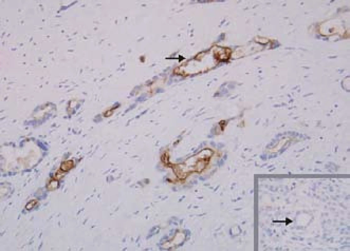 Exprese mezotelinu. Mezotelin je selektivně exprimován buňkami karcinomu pankreatu, exprese v normálním pankreatu není přítomna (vpravo dole).
Fig. 3. Mesothelin expression. Mesothelin is expressed selectively in pancreas cancer cells, expression is not found in normal pancreas (bottom right).