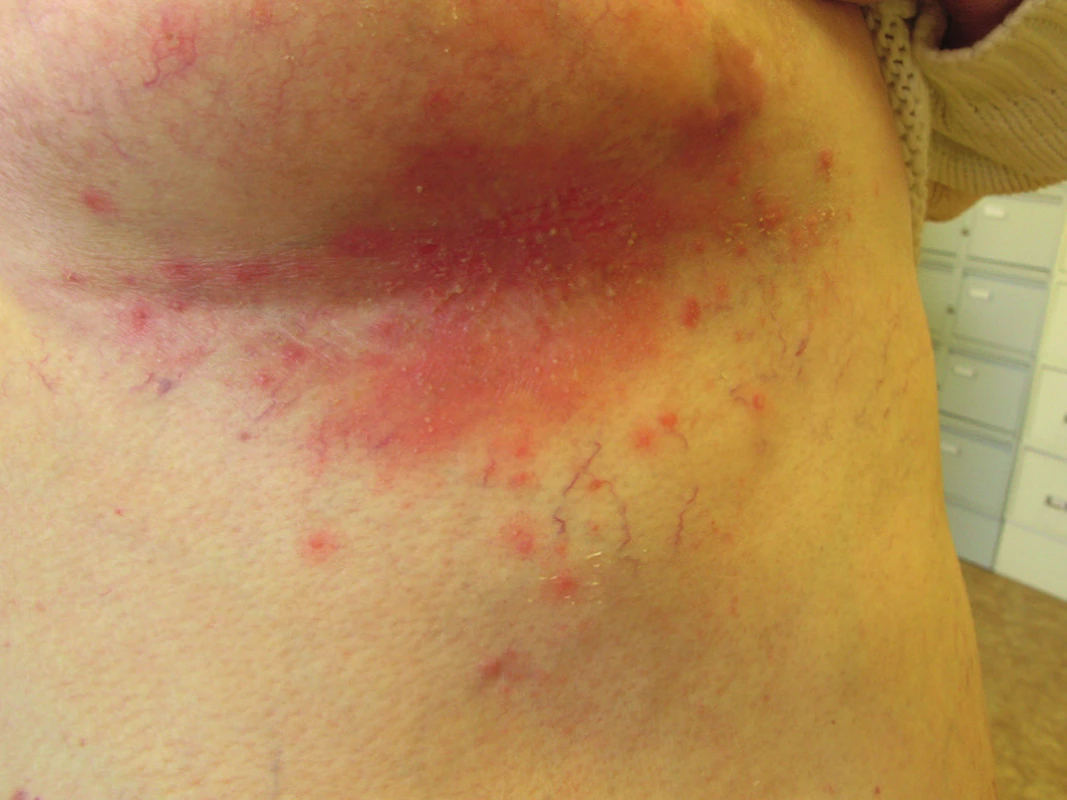 Candidosis intertriginosa – erytémová plocha pod prsem s pustulami a deskvamací