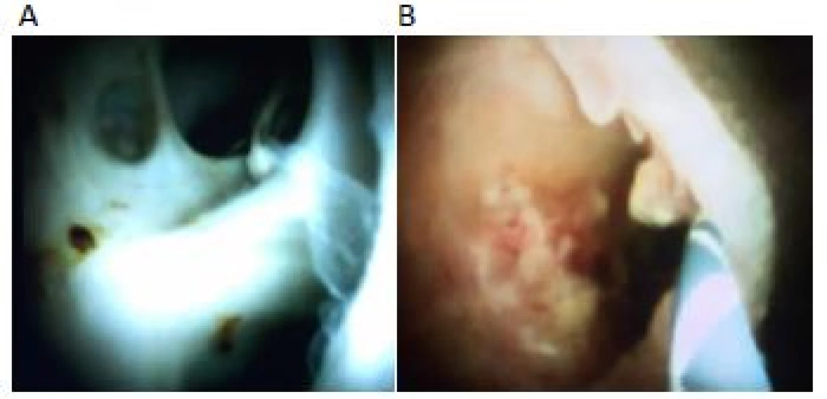 Normální cholangioskopický nález:
A – normální nález; B – adeherující koagulum a nekróza po
předchozí stentáži