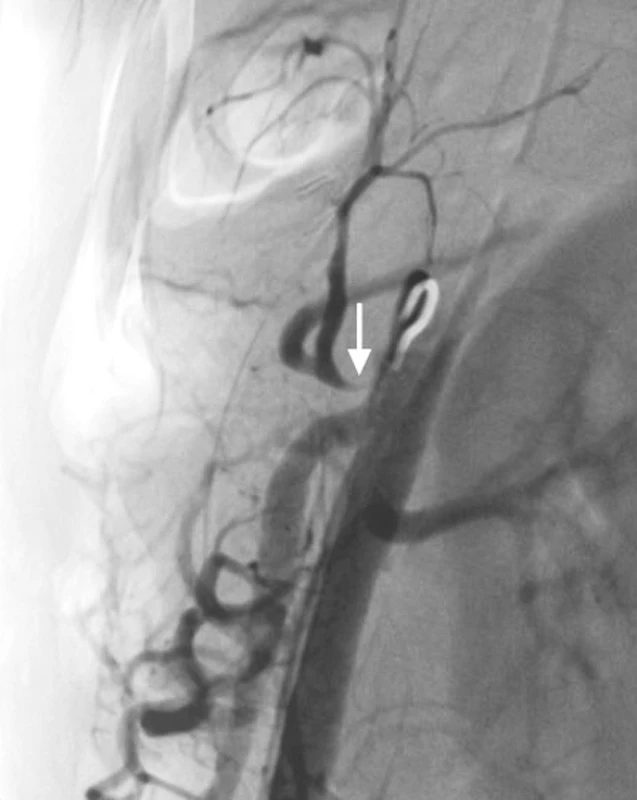 Angiografické vyšetření s průkazem krátké kritické stenózy těsně za odstupem truncus coeliacus. Stenóza průkazná při břišní aortografii (Obr. 2) i selektivní coeliakografii (Obr. 3)
Pic. 2 and 3. Angiography shows short critical stenosis at the origin of celiac trunk. The stenosis is evident in abdominal aortography (Picture 2) and selective celiacography (Picture 3)