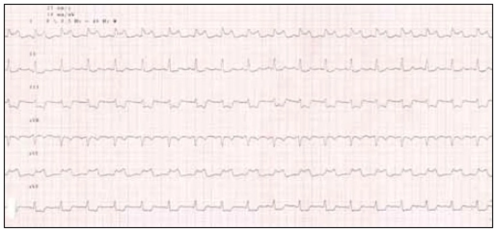 EKG končetinové svody, pozitivní nález při hyperventilačním testu.