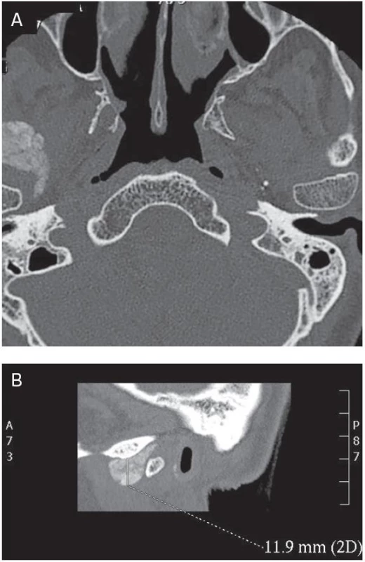 CT snímek TMK před operací v axiální (A) a boční (B) projekci