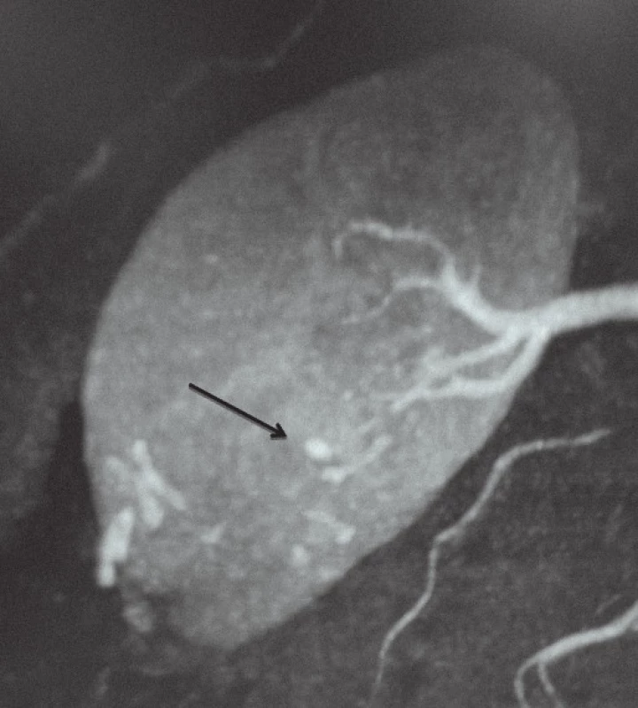 Reprezentativní nález pseudoaneurysmatu intrarenálních arterií (RAP). 5mm RAP bylo detekováno pomocí CT angiografie.